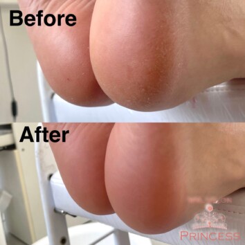 つくばみらい市 角質ケア ネイルサロンプリンセス